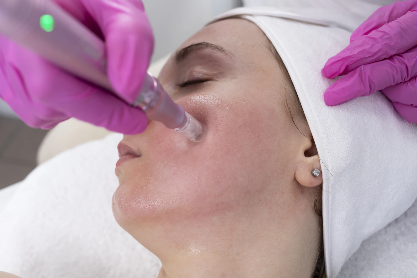 Skin Needling Aftercare: Looking After Your Skin After Treatment